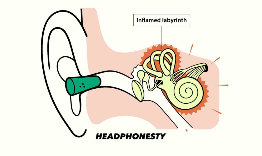 How earplugs cause labyrinthitis